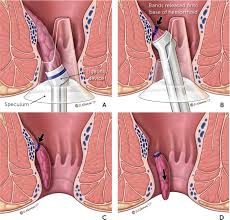 Hemorrhoids Diagnosis And Treatment Options American