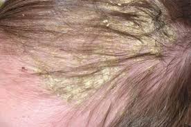 It could be a sign of a nutritional problem, such as iron what if my baby is completely bald? Pin On Dry Scalp