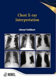 Image result for Chest XRay Interpretation