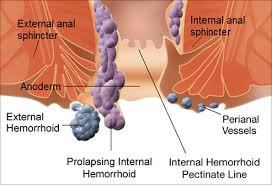 Find & download free graphic resources for hemorrhoid treatment. Pictures Of Hemorrhoids What Hemorrhoids Look Like