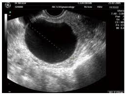 Callen's ultrasonography in obstetrics and gynecology. Ovarian Simple Cysts In Asymptomatic Postmenopausal Women Detected At Transvaginal Ultrasound A Review Of Literature