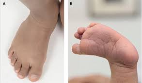 Gulzar raja — jalebi niyan jamal bate oth tor baby ho 05:04. Primary And Hospital Care Teil 1 Auffalligkeiten Der Unteren Extremitat