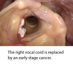 Throat cancer is often grouped into two categories: Laryngeal Cancer The Metrohealth System