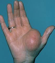 Lipoma Orthoinfo Aaos