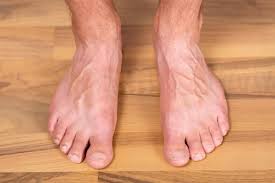 Image result for diabetic toes