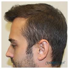 Greft Star Adli Kullanicinin Sac Ekimi Samsun Panosundaki Pin Sac Galeri