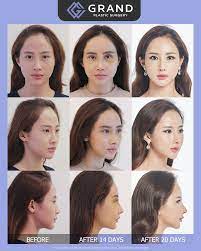 Elegance And Beauty Is What Grand Offers Enhancing Features Focusing On The Center Of The Face Can Create Dimension Increase Aura And Make Your Face Appear S