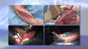 Escharotomy is surgical incision through the eschar to release the constriction, thereby restoring distal circulation and allowing for adequate ventilation. Escharotomy Procedures For Burn Patients Youtube