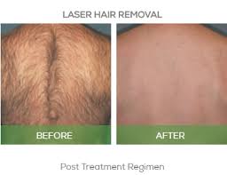 And would a single method of laser hair removal suffice for under the chin hairs, arm pit hairs, belly hairs, hair on breasts, arms, legs, upper lips, side burns, toes, buttocks or different kinds of laser hair. Laser Hair Removal Cade Clinique