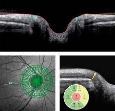 It's often linked to a buildup of pressure inside your eye. Fda Clearance To Market Spectralis Oct Gmpe Heidelberg Engineering Inc
