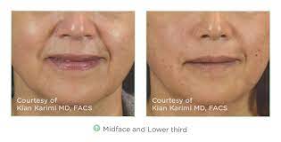 Tighten loose neck skin without surgery loose neck skin may be tightened by undergoing a nonsurgical procedure. Tightening Skin On The Lower Face Without Surgery Radiance Skincare Laser Medspa Wheaton Il