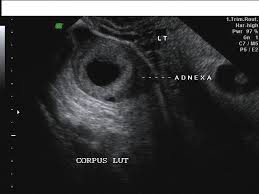 Image result for corpus luteum sonography)