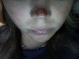 Beim sonnenschutz nicht kleckern, sondern klotzen. Brandblase Ist Offen Nach Sonnenbrand Was Tun Wunde