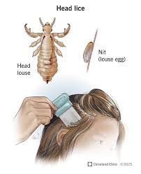 Image result for lice vs nits