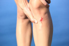 A usually harmless abrasion of the upper skin layers that occurs after falling on knees, hands or elbows, or scratching over a rough surface with some skin coming off subsequently. Graze