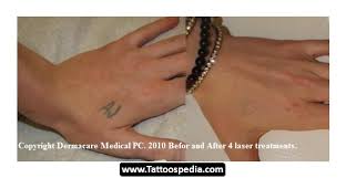 The short answer to this question is a resounding yes. essentially, laser removal of a tattoo consists of removing the ink that is deeply embedded beneath the skin's surface. 64 Laser Tattoo Removal Does It Hurt