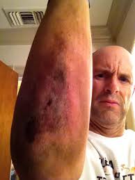 I felll with my bike last night as i was so tired and forgot to turn right  in time as i took a sharp right turn and boom