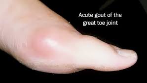 Image result for gout symptoms toe
