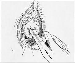 We would like to show you a description here but the site won't allow us. Tecnica De Mcdonald Comprobacion Del Cierre Del Canal Cervical Al Anudar Download Scientific Diagram