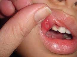 Even if you are someone who has these symptoms, it still might make it easier to know you have a canker sore for sure when you see pictures of what one looks like. Caring For A Toddler With Mouth Sores A List Of Foods And More