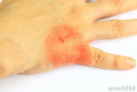 A milder type, known as irritant contact dermatitis, involves redness or a stinging feeling where sunscreen was applied. What Are The Signs Of A Sunscreen Allergy With Pictures
