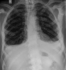 Knochenmetastase Wikipedia