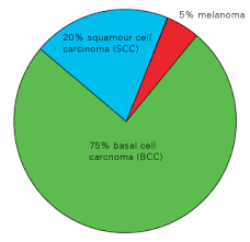 Skin Cancer Cc By Songkran Ellis Infographic