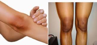 Daki sendiri disebabkan oleh penumpukan sel kulit mati serta keringat dan debu pada kulit. Cara Menghilangkan Daki Di Lutut Dan Siku