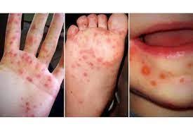 Image result for Hand foot and mouth disease HFMD roof of mouth