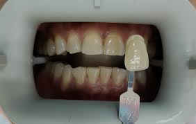 Lisateavet klinik mediviron cheras (taman connaught) kohta leiate veebisaidilt mediviron.com.my. Klinik Pergigian City City Dental Cheras Dentiståº·ä¹åŸŽå¸‚ç‰™ç§' Posts Facebook