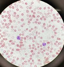 Image result for Peripheral Smear