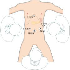 The reasons for opting to use palmer's point in such situations is concern about the possibility Laparoscopic Radical Left Pancreatectomy For Pancreatic Cancer Surgical Strategy And Technique Video Protocol