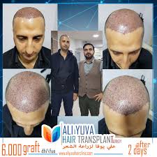 Ali Yuva Hair Clinic Adli Kullanicinin Ali Yuva Sac Ekimi Panosundaki Pin Sac