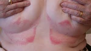 Følfekker som klør eller blør bør hos aleris har vi som rutine å gjennomgå alle føflekker på kroppen med dermatoskop, slik at vi kan. Soppinfeksjon Pa Kroppen Candidiasis Nhi No