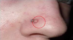 How To Get Rid Of Nose Piercing Bump With Toothpaste Youtube