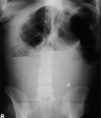 Image result for Adynamic Ileus