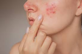 Image result for acne face