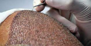 Al giorno d'oggi l'innovazione tecnologica e la . Il Turismo Dei Calvi Trapianto Di Capelli Dalla Puglia Alla Turchia Masterx