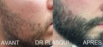 Greffe barbe & moustache par la methode d'extraction folliculaire. Greffe De Barbe 6 Mois Pour Arborer Une Belle Barbe De Bucheron