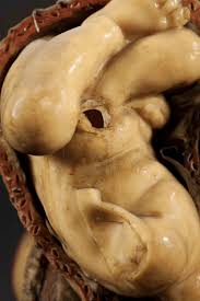 Image result for Brow Presentation