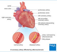 Image Showing A Coronary Artery Affected By Atherosclerosis Coronary Heart Disease Coronary Coronary Arteries