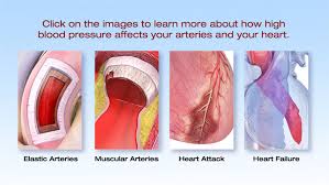 Symptoms of hypertension (high blood pressure) are usually silent. What Is High Blood Pressure American Heart Association