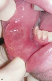 Image result for syphilis ulcer
