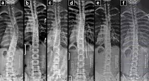 متى يكون حزام اعوجاج العمود الفقري ضروريًا؟