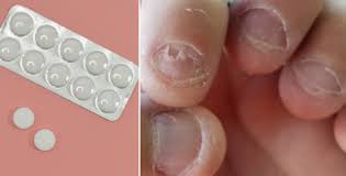 Acylpyrin® 500 mg / 10 tablet. Obycejny Acylpyrin A Jeho Neobycejne Pouziti Pomuze Na Polamane Nehty I Na Problematickou Plet Styl Plus Cz