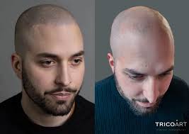 Tricopigmentazione a Siena