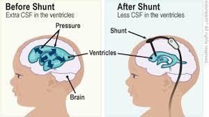 First Diagram Is Before Shunt With Extra Csf In The Ventricles Second Diagram Is After Shunt With Less Csf In The Ven Vp Shunt Nursing Notes Pediatric Nursing