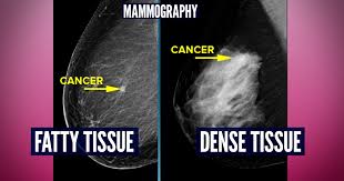 This can make it harder for your radiologist to spot signs of breast cancer, since dense tissue and tumors both look white in mammogram images. Do You Have Dense Breasts You May Need More Than A Mammogram