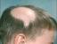 Hair Disease Types