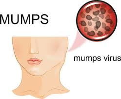 Mumps Ursachen Symptome Behandlung Medlexi De